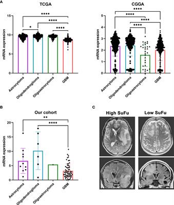 Suppressor of fused associates with dissemination patterns in patients with glioma